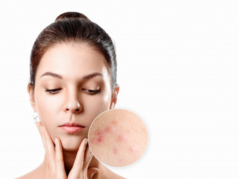 Problemi con le “cicatrici da acne” Scopri la chirurgia estetica